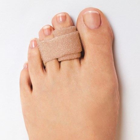 Image of Foot with Hammertoe, Socal Foot Ankle Doctors, Hammertoe treatment Los Angeles