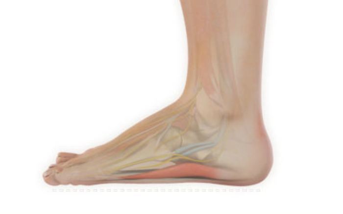 Image of Adult Flat Foot, Socal Foot Ankle Doctors, Adult Flatfoot treatment