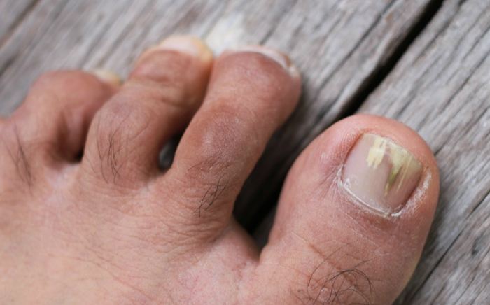 Image of Foot showing the condition of Fungal Toe Nails, Socal Foot Ankle Doctors, Common Foot & Ankle Disorders