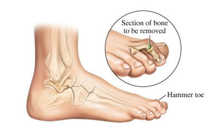 Image of Hammertoe, Socal Foot Ankle Doctors, Hammertoe Deformity