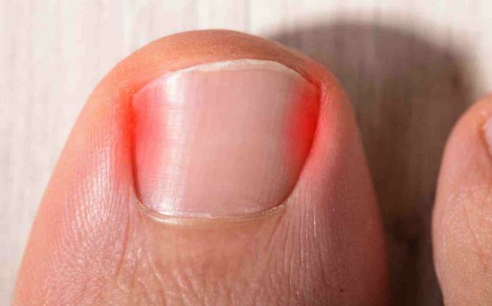 image of ingrown toe nails, Socal Foot Ankles Doctors, Common Foot & Ankle Disorders