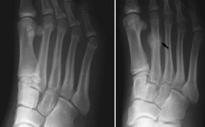 Image of Foot condition showing Metatarsal Stress Fractures, Socal foot Ankles Doctors, Metatarsal Stress Fractures