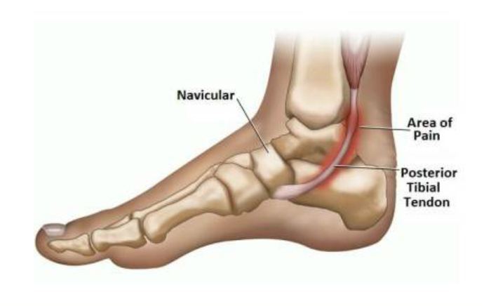 Image showing Foot with posterior tibial tendon dysfunction, Socal Foot Ankle doctors, Common Foot & Ankle Disorders