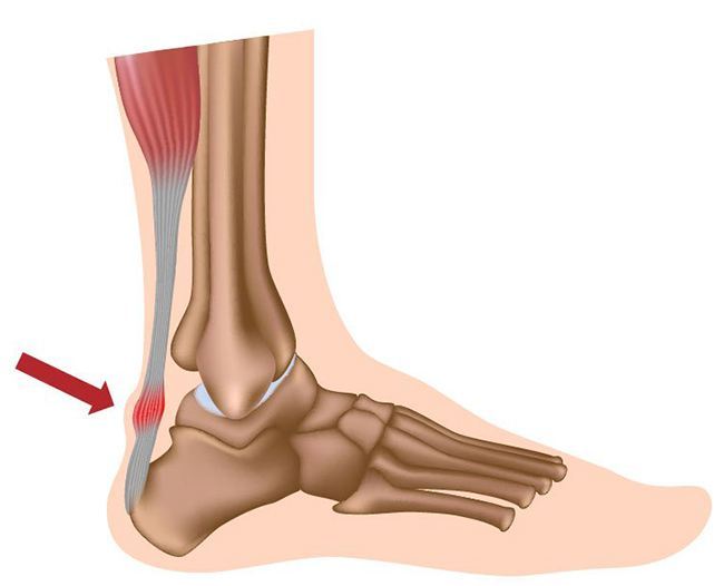 Image of Foot Showing the condition for shockwave therapy treatment, Socal Foot Ankle Doctors, Shockwave therapy Los Angeles