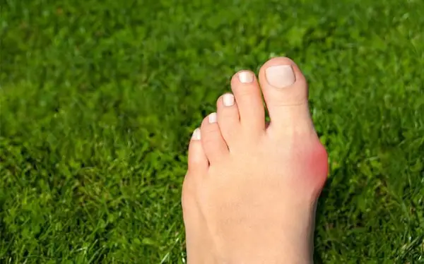 Image of Foot with Bunion condition, Socal Foot Ankles Doctors, Common Foot & Ankle Disorders