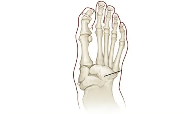 Image of Charcot Joint Disease Neuroarthropathy