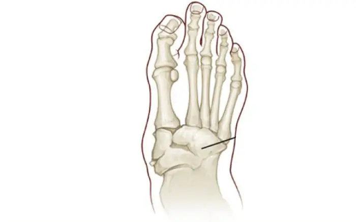 Image of Charcot Joint Disease Neuroarthropathy
