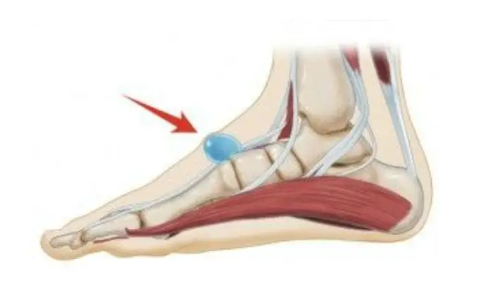Image of Foot showing Ganglion cysts , Socal Foot Ankle Doctors, Ganglion cysts