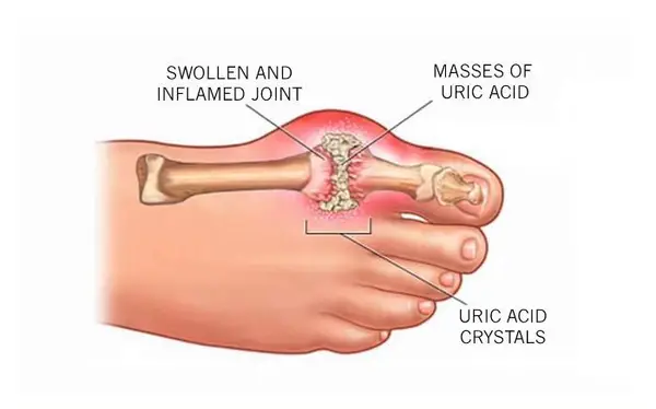Image of Foot condition of Gout , Socal Foot Ankle Doctors, Gout | Gout Treatment