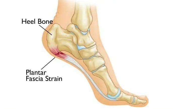 Image of Foot showing condition of heel spur, Socal Foot Ankle Doctors, Common Foot & Ankle Disorders