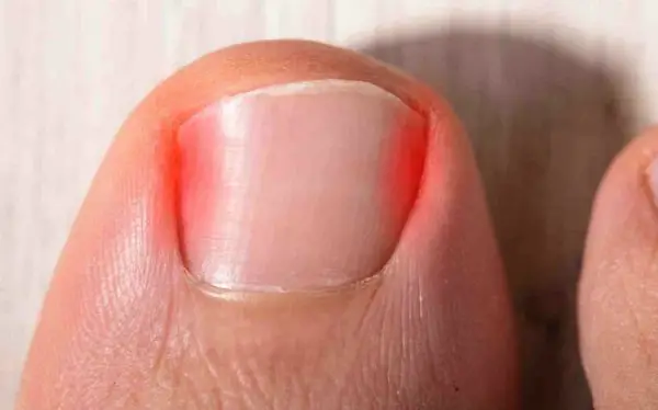 image of ingrown toe nails, Socal Foot Ankles Doctors, Common Foot & Ankle Disorders