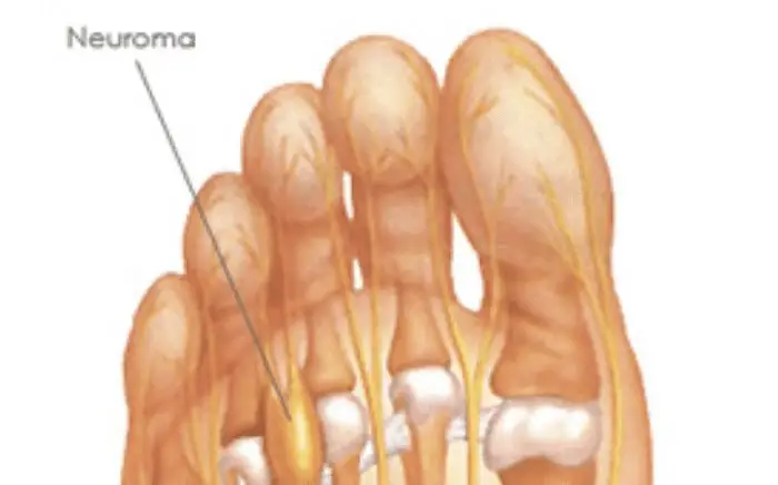 Image of a Foot showing the condition Neuroma, Socal Foot Ankle Doctors, Neuroma