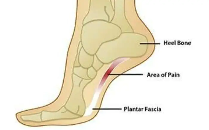 Image of Foot showing the condition for plantar fanciitis, Socal Foot Ankle Doctors, Foot & Ankle Treatments
