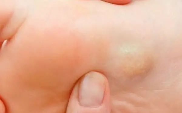 Image of Foot condition showing Lumps and Bumps on foot, Socal foot Ankle Doctors, Common Foot & Ankle Disorders