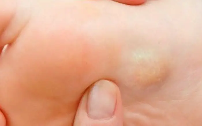 Image of Foot condition showing Lumps and Bumps on foot, Socal foot Ankle Doctors, Common Foot & Ankle Disorders