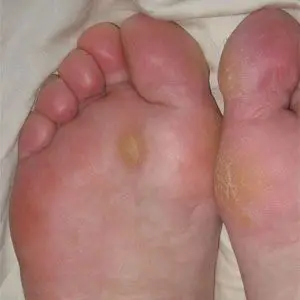 Image of Foot Showing the condition of Corn and Calluses, Socal Foot Ankle Doctors , Foot & Ankle Treatments