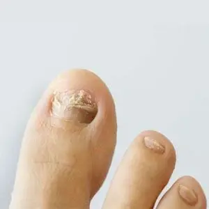 Image of Fungal nail Treatment, Socal Foot Ankle Doctors, Foot & Ankle Treatments