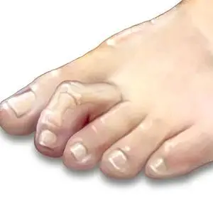 Image of hammertoe surgery,Socal Foot and Ankle Center