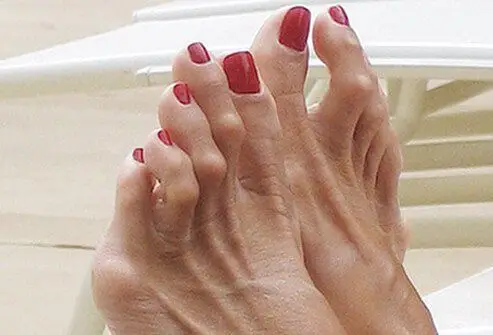 Image of Foot with Hammertoe, Socal Foot Ankle Doctors, Hammertoe treatment Los Angeles