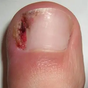 Image of Ingrown toe nail, Socal Foot Ankle Doctors, Foot & Ankle Treatments