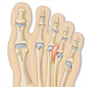 Image of Foot showing neuroma treatment, Socal Foot Ankle Doctors, Foot & Ankle Treatments