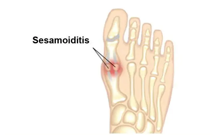 Image of Sesamoiditis Foot Condition, Socal Foot Ankle Doctors, Sesamoiditis Condition