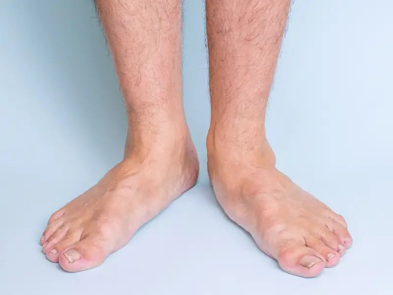 Flat Feet