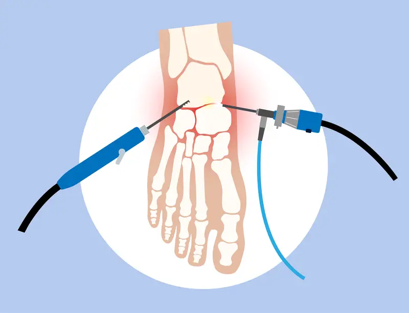 Foot & Ankle Arthroscopy
