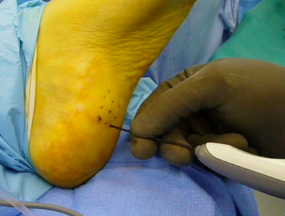 Topaz Procedure