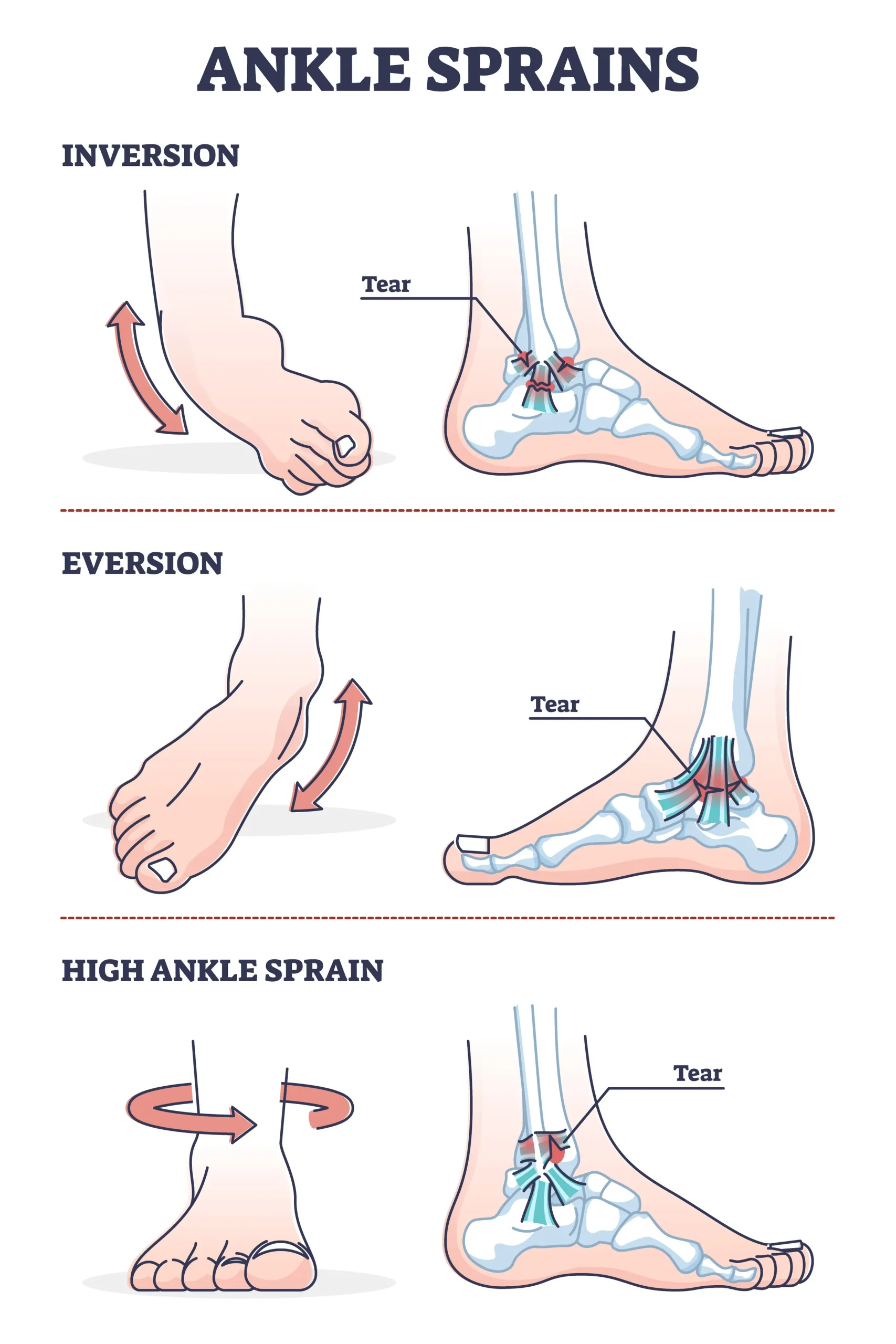 Ankle Sprains & Instability