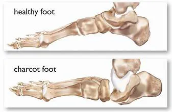 Charcot Foot Management