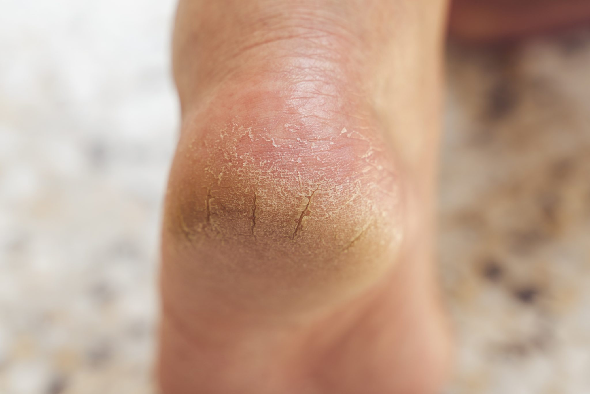Image of Charcot Joint Disease Neuroarthropathy