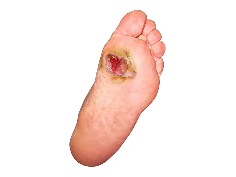 Image of Foot with condition Tarsal Tunnel Syndrome, Socal Foot Ankle Doctors, Tarsal Tunnel Syndrome