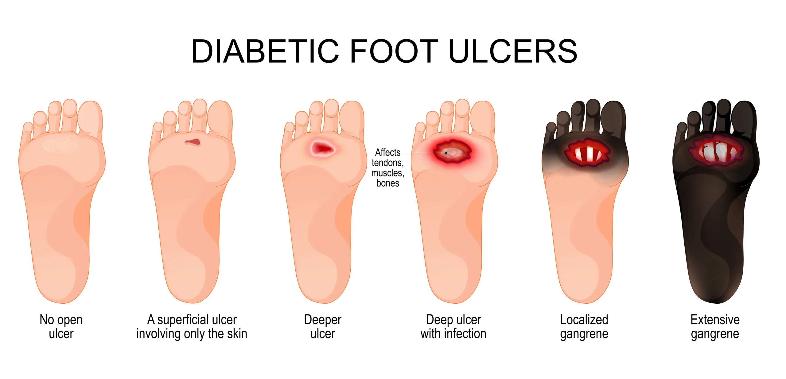 Foot Ulcer Management & Limb Salvage