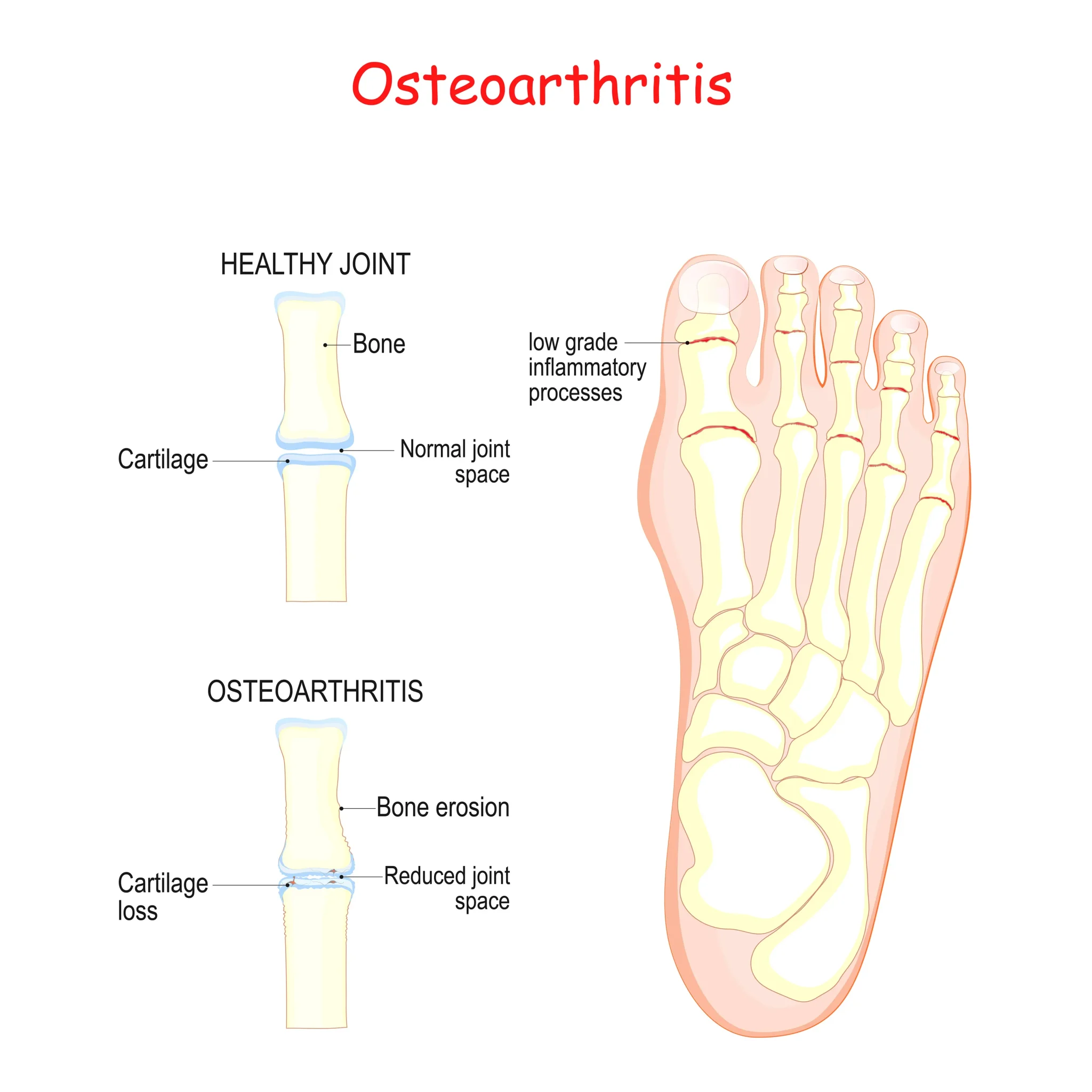 Osteoarthritis of the Foot and Ankle