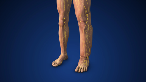 Lymphedema (Chronic Swelling)