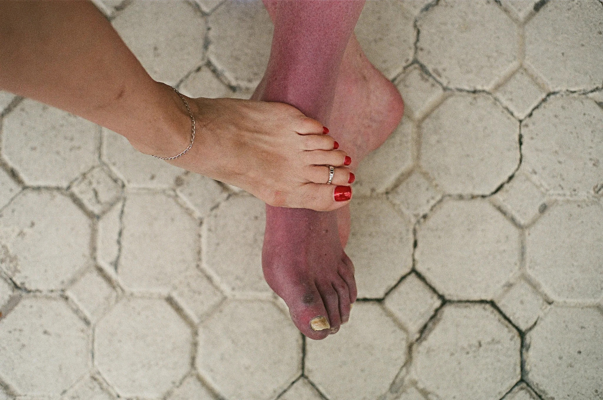Image showing Foot with posterior tibial tendon dysfunction, Socal Foot Ankle doctors, Common Foot & Ankle Disorders