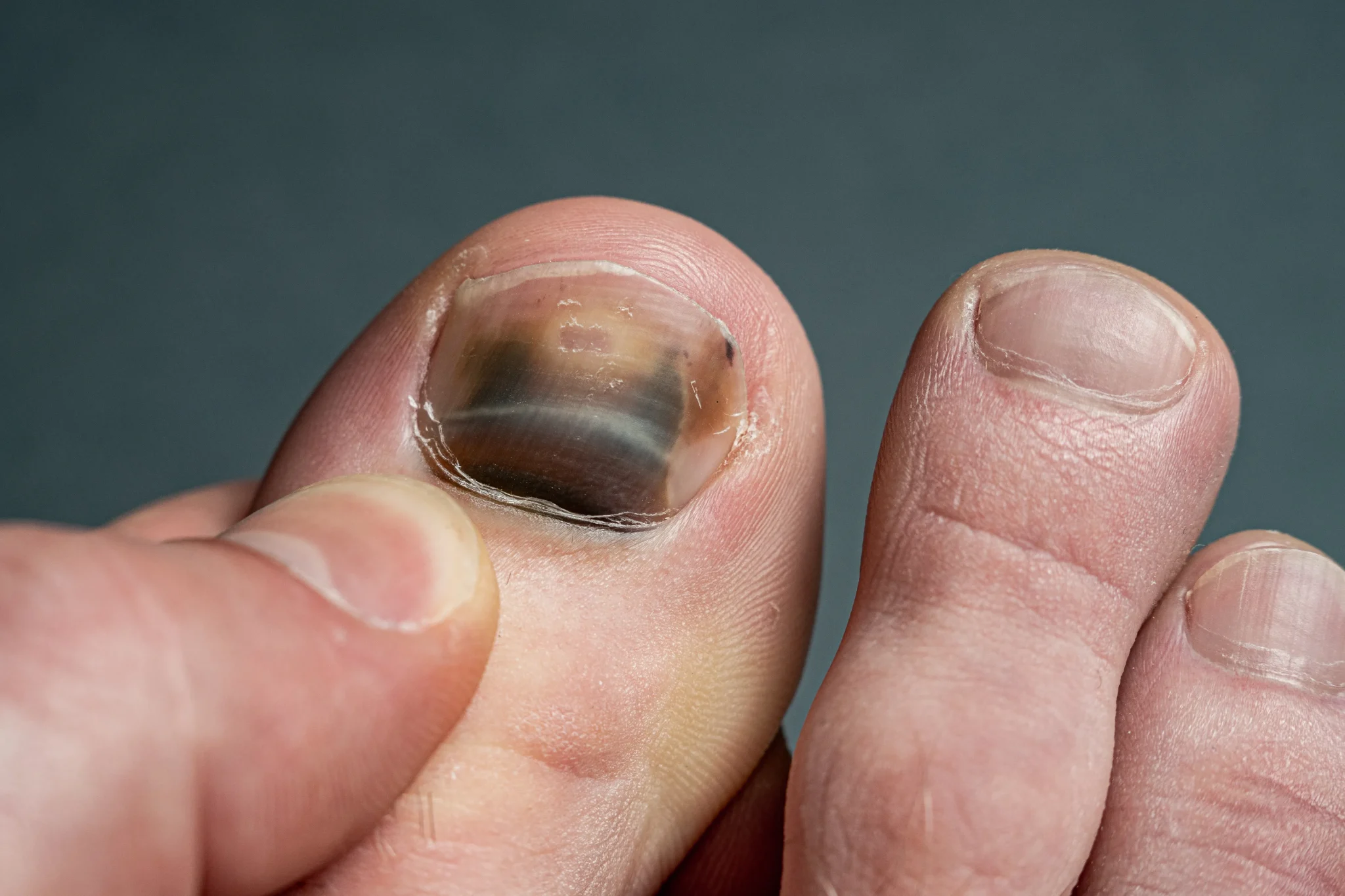 Image of Foot with condition Tarsal Tunnel Syndrome, Socal Foot Ankle Doctors, Tarsal Tunnel Syndrome