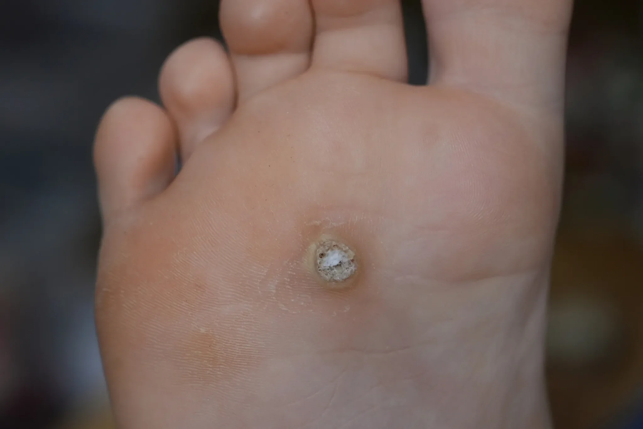 Plantar Warts (Viral Warts)
