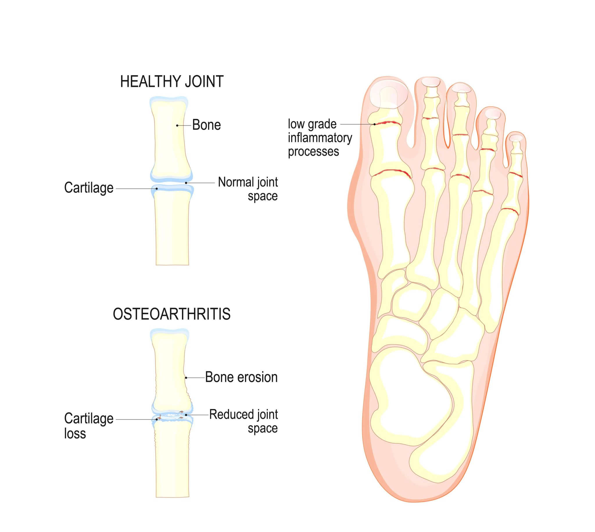 Image of Foot with condition Tarsal Tunnel Syndrome, Socal Foot Ankle Doctors, Tarsal Tunnel Syndrome